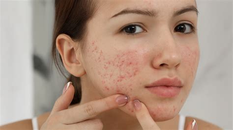 dating with cystic acne
